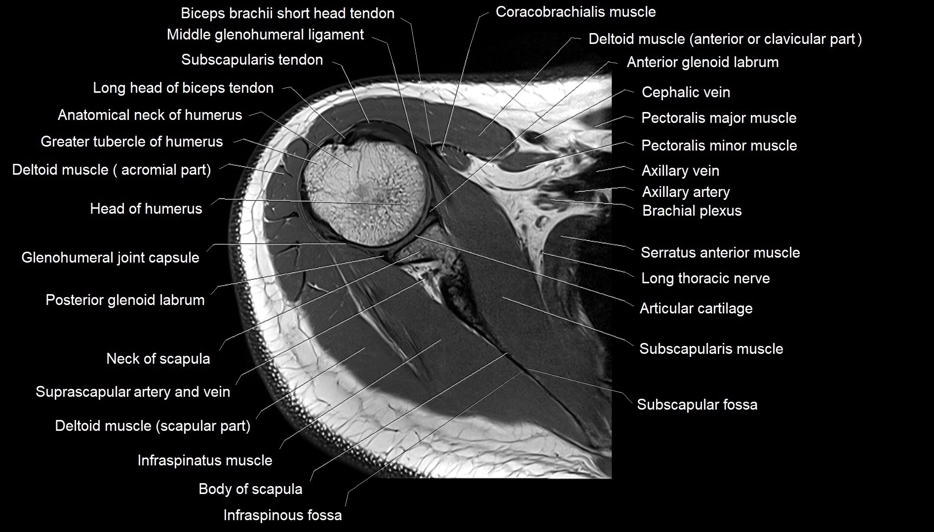 Shoulder cross sectional anatomy MRI 3T axial image 17.webp